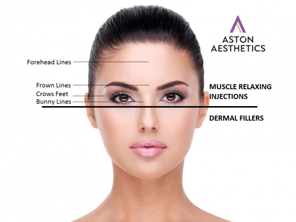 botox buckinghamshire