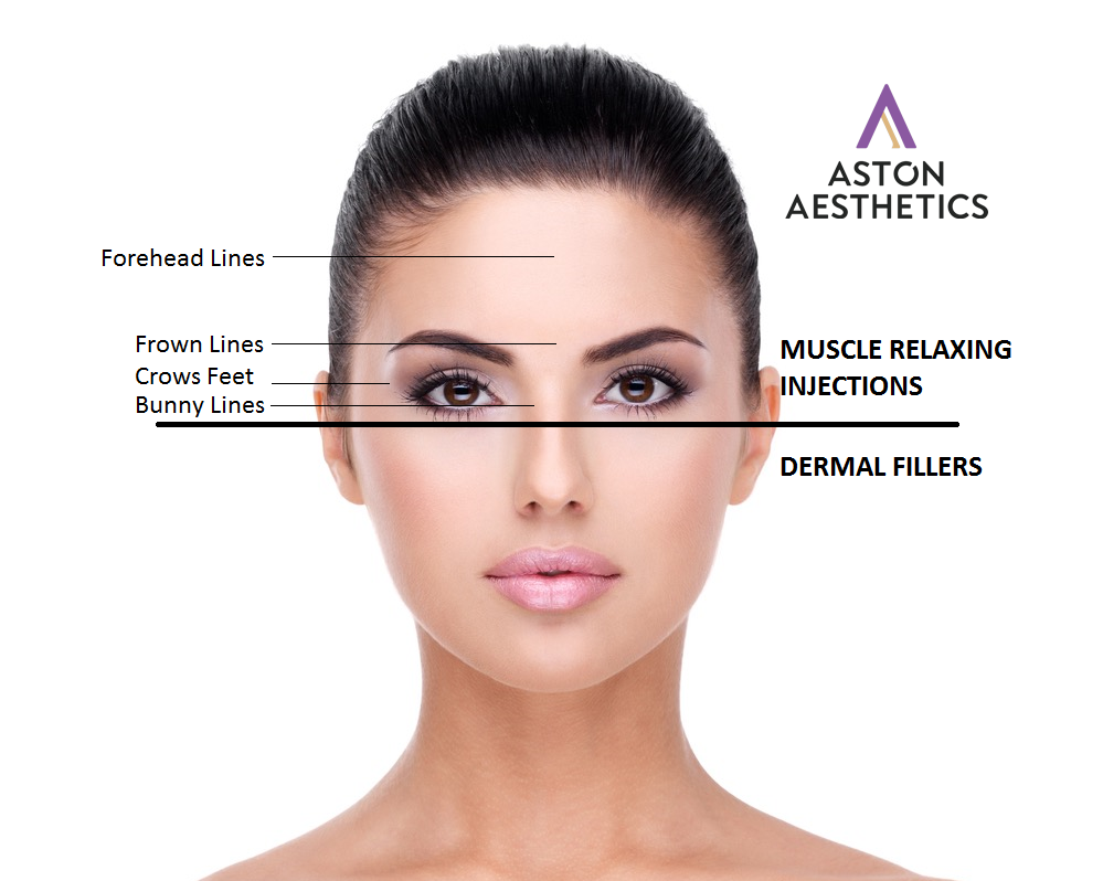 botox buckinghamshire